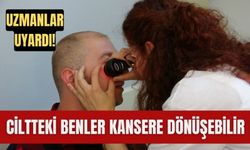 Uzmanlar uyardı: Ciltteki benler kansere dönüşebilir