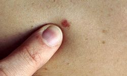 Vücuttaki her leke masum olmayabilir: ‘ABCDE’ kuralına dikkat