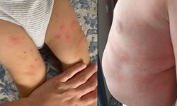 Çocuklarda besin alerjilerine dikkat