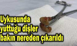 Uykusunda yuttuğu dişler bakın nereden çıkarıldı (Video)