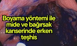 Boyama yöntemi ile mide ve bağırsak kanserinde erken teşhis (Video)