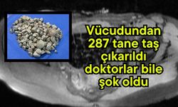 Vücudundan 287 tane taş çıkarıldı, doktorlar bile şok oldu (Video)