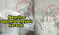 Beynine saplanan implant hayatını kararttı