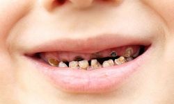 "Çocukların büyük kısmı yaşamının bir döneminde çürük ile karşılaşıyor"