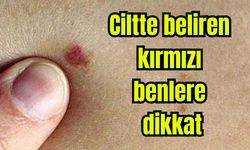 Ciltte beliren kırmızı benlere dikkat