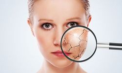 Kışın kuruyan cildi soğuğa yormayın