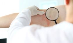 Uzmanı Uyardı: Baharda Cilt Hastalıkları Artıyor!