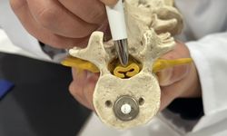 Beldeki Gizli Tehlike: Spinal Stenoz ve Felç Riski!