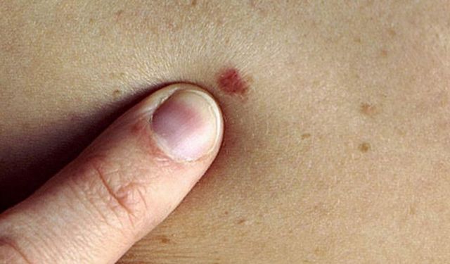 Vücuttaki her leke masum olmayabilir: ‘ABCDE’ kuralına dikkat