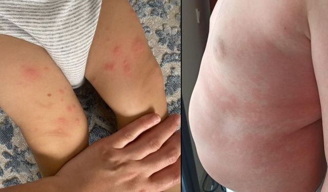 Çocuklarda besin alerjilerine dikkat