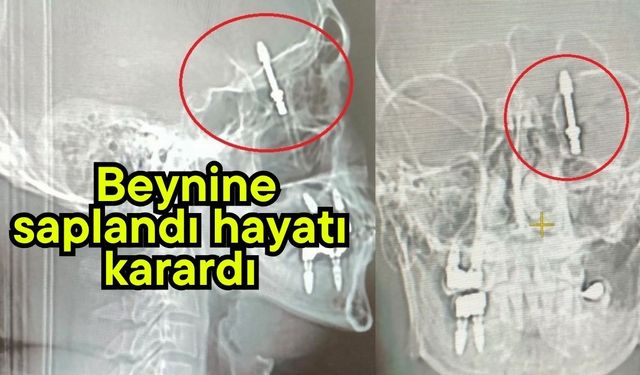 Beynine saplanan implant hayatını kararttı