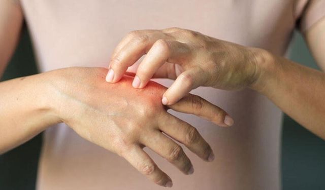 "Kış aylarında görülen deri hastalıklarına dikkat"