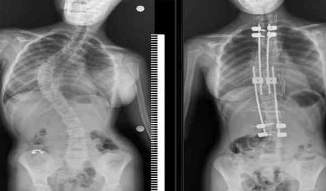 "Skolyoz ergenlikte hızla ilerleyebiliyor"