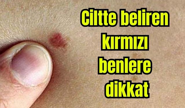 Ciltte beliren kırmızı benlere dikkat