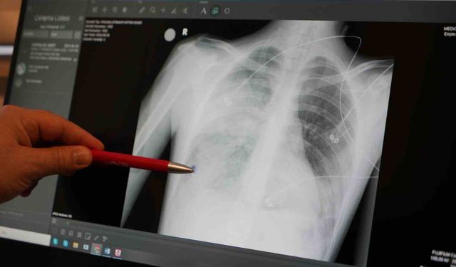 "Zatürreye neden olan etkenler sonbahar kış aylarında artış gösteriyor"