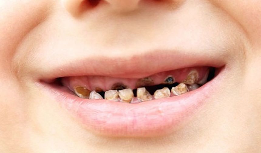 "Çocukların büyük kısmı yaşamının bir döneminde çürük ile karşılaşıyor"