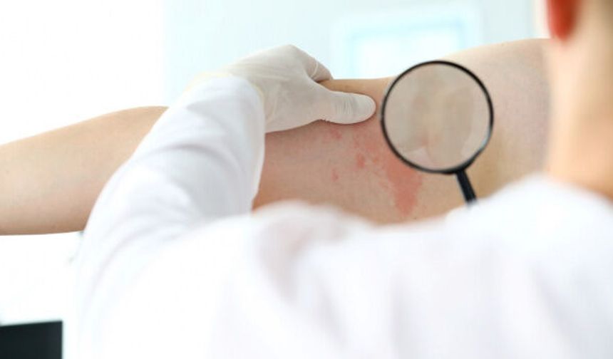Uzmanı Uyardı: Baharda Cilt Hastalıkları Artıyor!